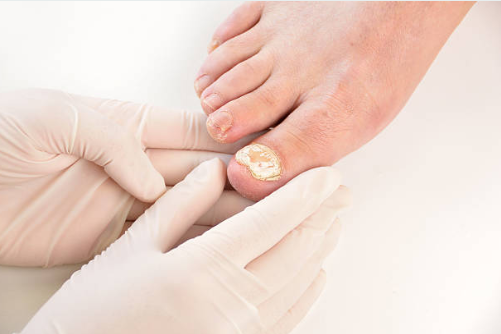 Reduction & management of thick/fungal nails