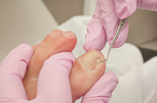Management of ingrown toenails